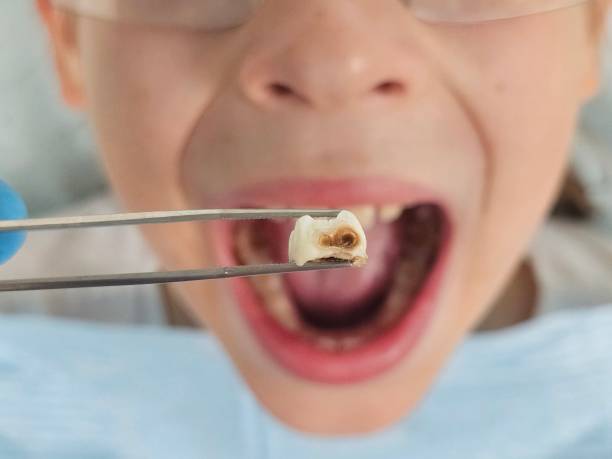 Best Emergency Treatment for Dental Infections or Abscesses in West Fairview, PA