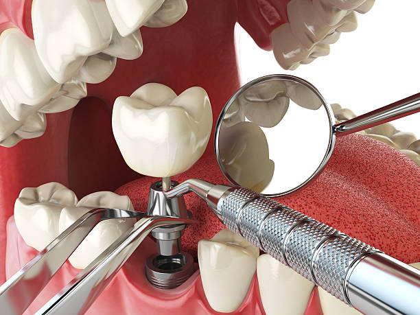 Best Urgent Care for Lost Fillings or Crowns in West Fairview, PA